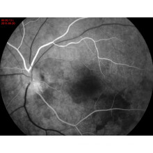 Ffa Mydriatic & Non-Mydriatic Fundus Camera Pl-Ber